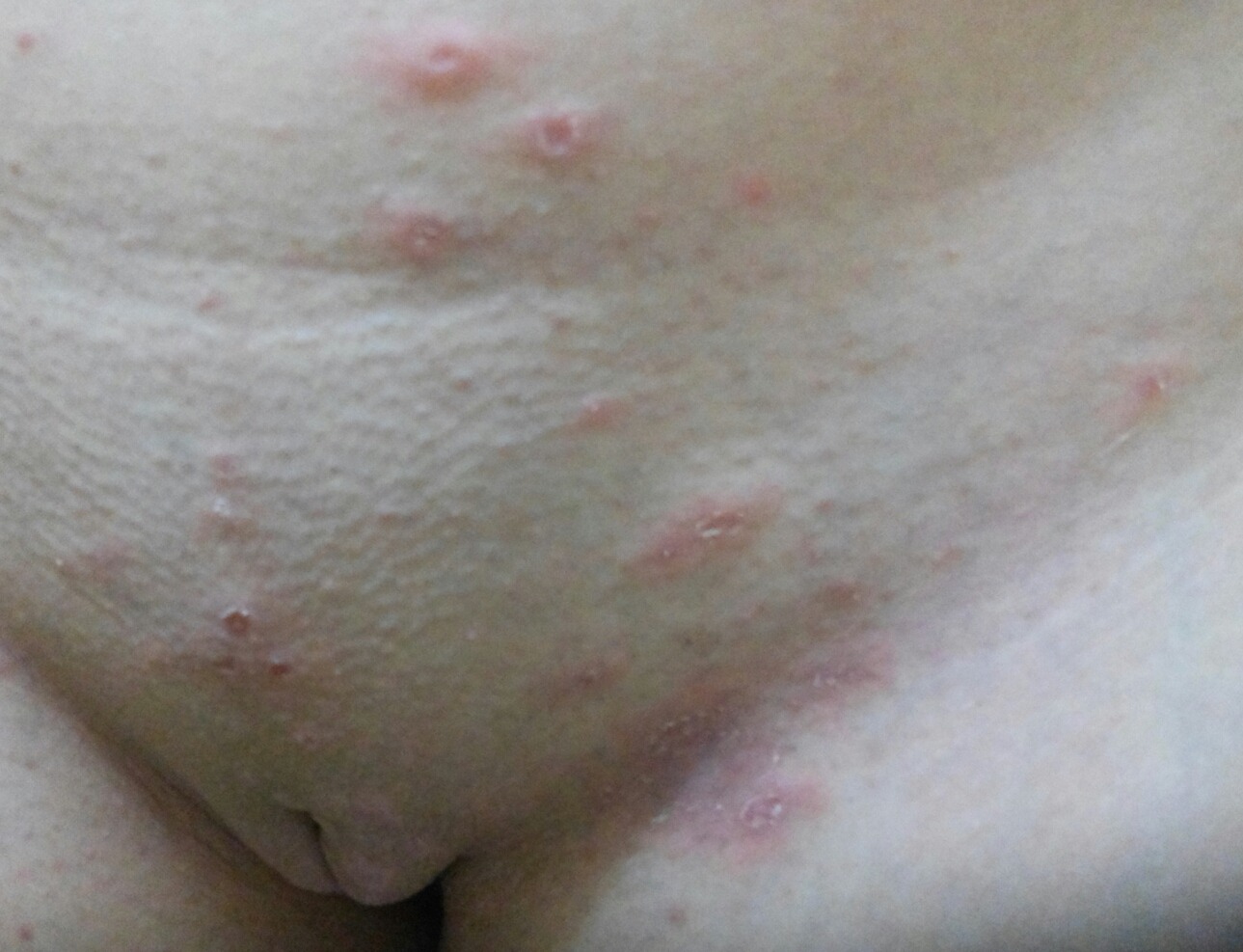 аллергия на груди у беременной фото 107