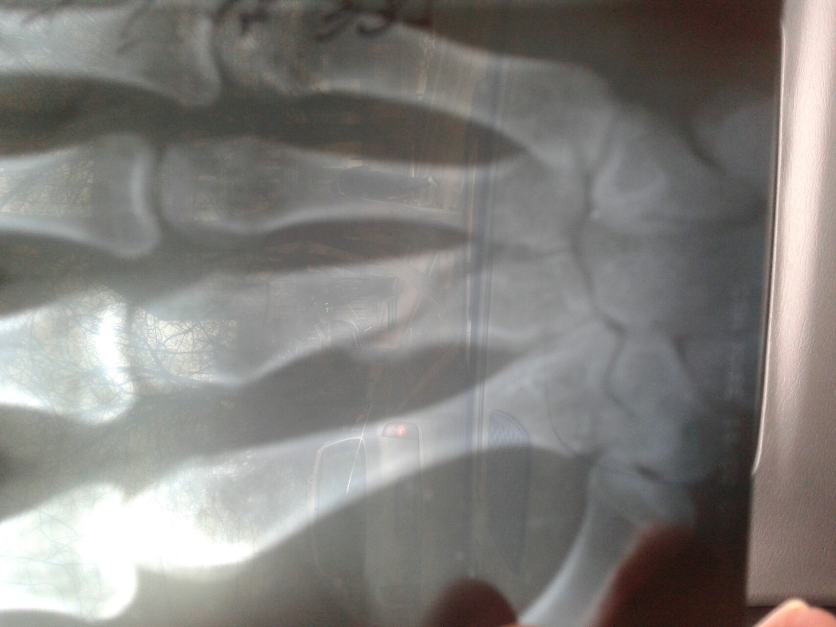 Открытый перелом фаланги. Плдголовчатый переломпроксимальной фаланги. Перелом основания фаланги пальца. Гипоплазия средней фаланги 5 пальца. Кольцевидный перелом основания.