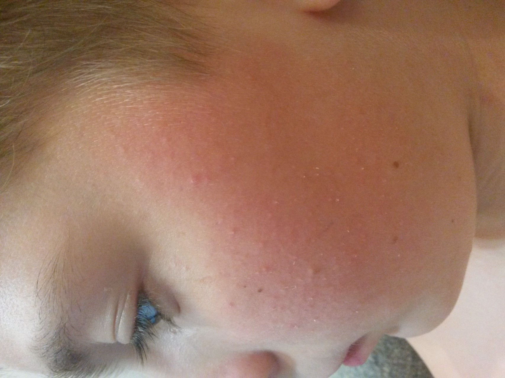 Ребенку год красные щеки. Высыпания на лице у ребенка. Аллергическая мелкая сыпь на лице.