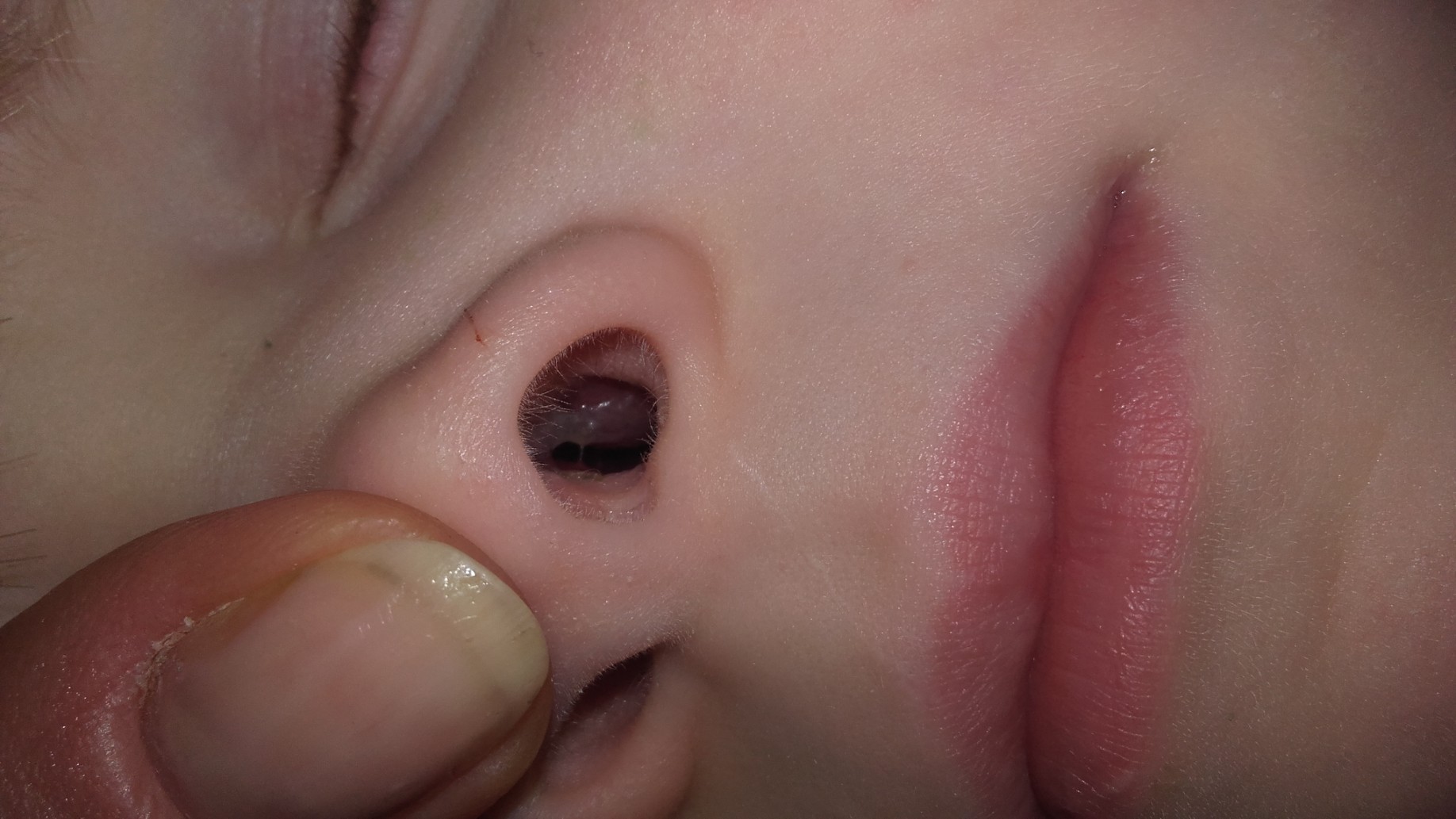 Шарики в носу - Вопрос лору - 03 Онлайн