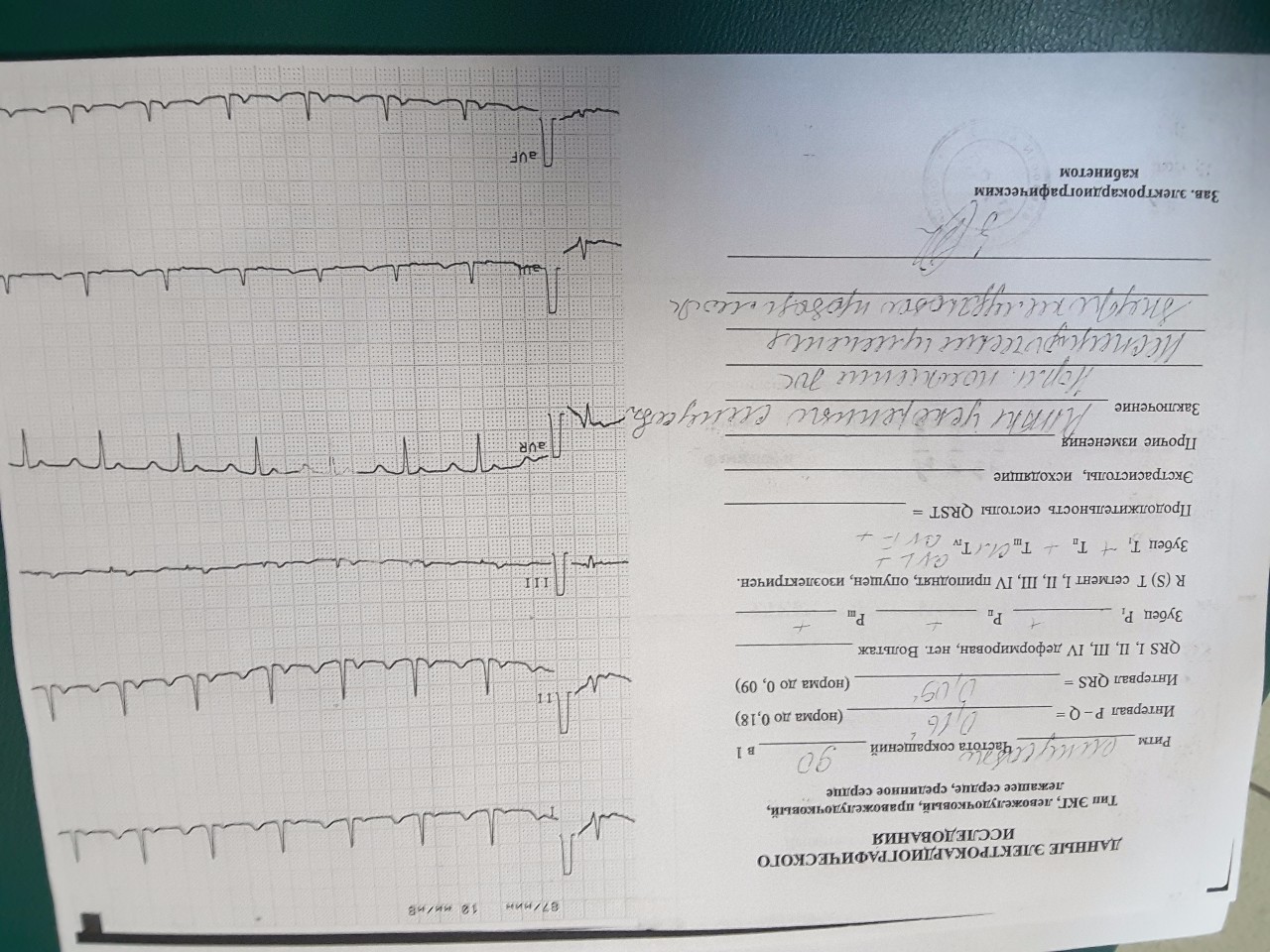 Кардиология расшифровка. Заключение ЭКГ. Расшифровка ЭКГ образец. Справка по ЭКГ. Протокол ЭКГ исследования.