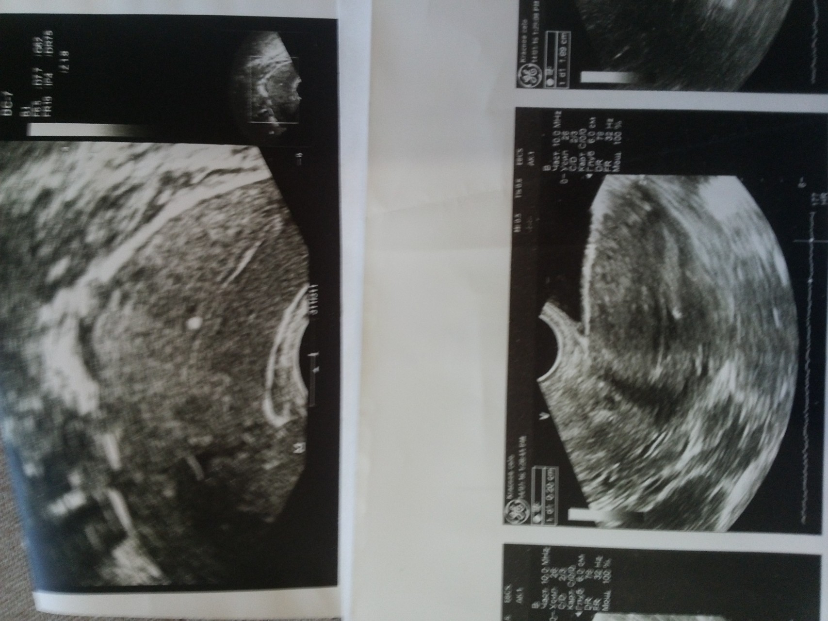 УЗИ после переноса эмбрионов