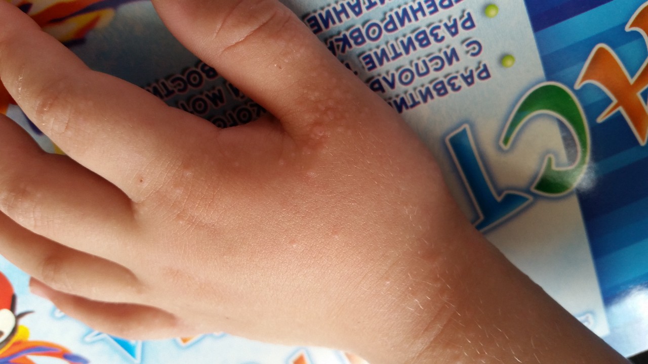 Сыпь на руках у ребенка Вопрос дерматологу 03 Онлайн