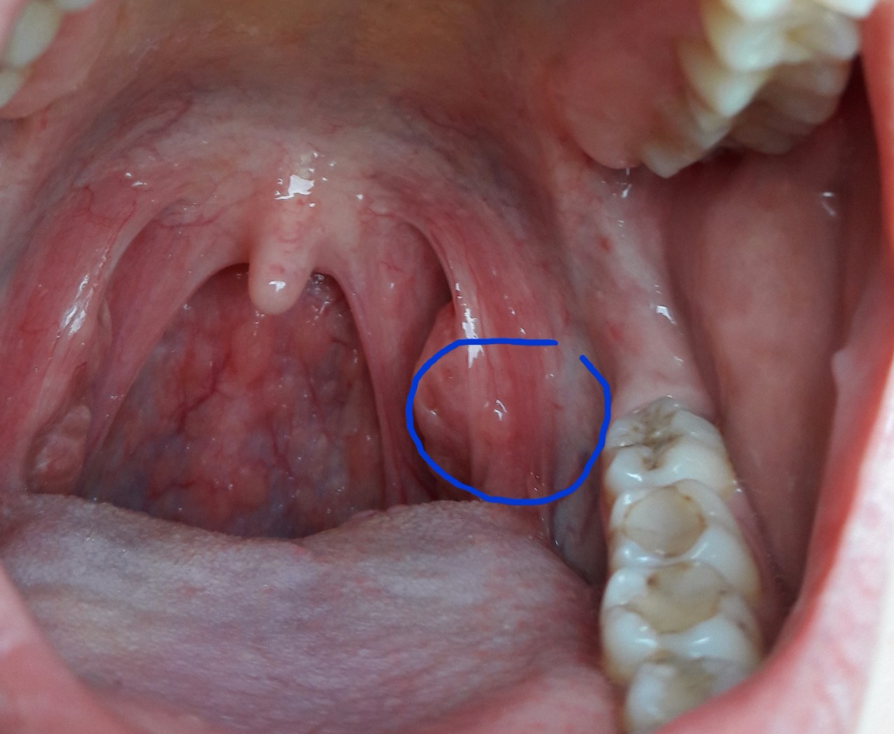 Образование на миндалине фото