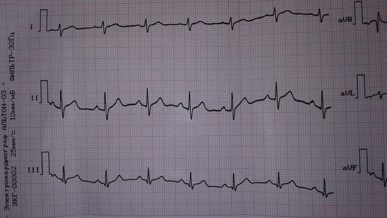 Мерцание предсердий на экг фото