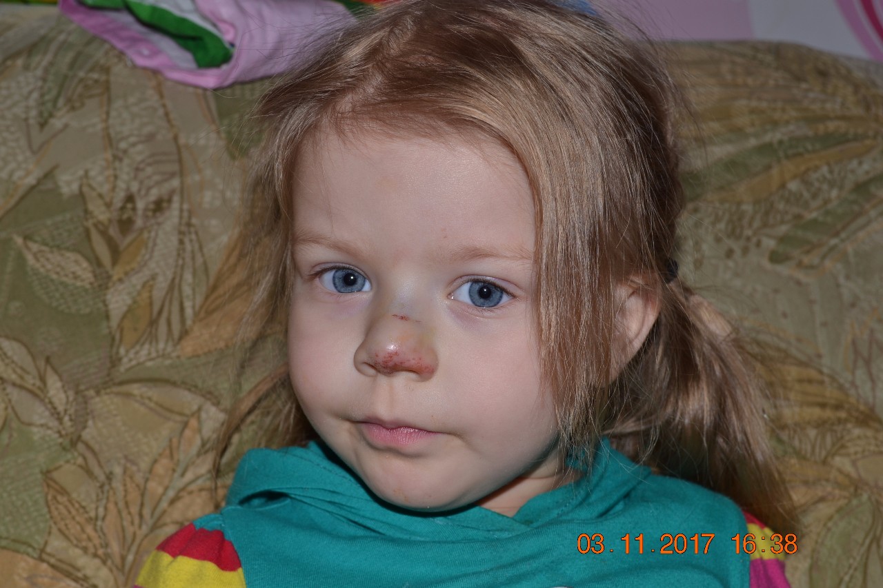 Как выглядит сломанный нос у ребенка фото