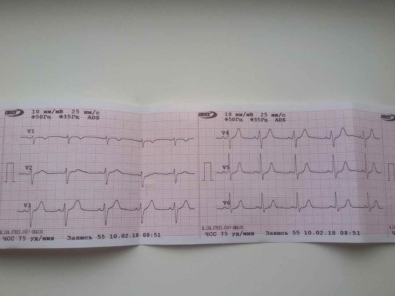 Экг сочи. Нормальная ЭКГ. Нормальная кардиограмма сердца у взрослого. ЭКГ сердца норма. Нормальный снимок ЭКГ.