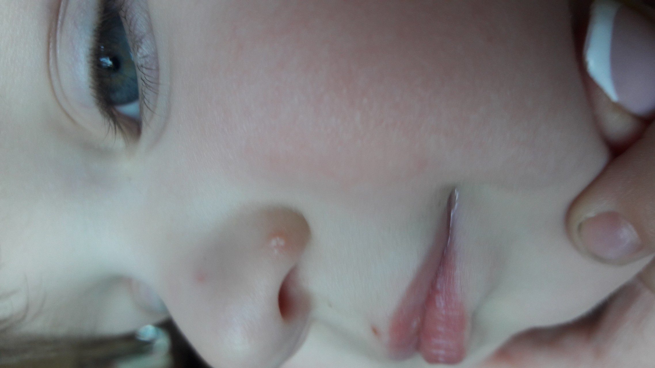 Белые прыщи на носу у ребенка