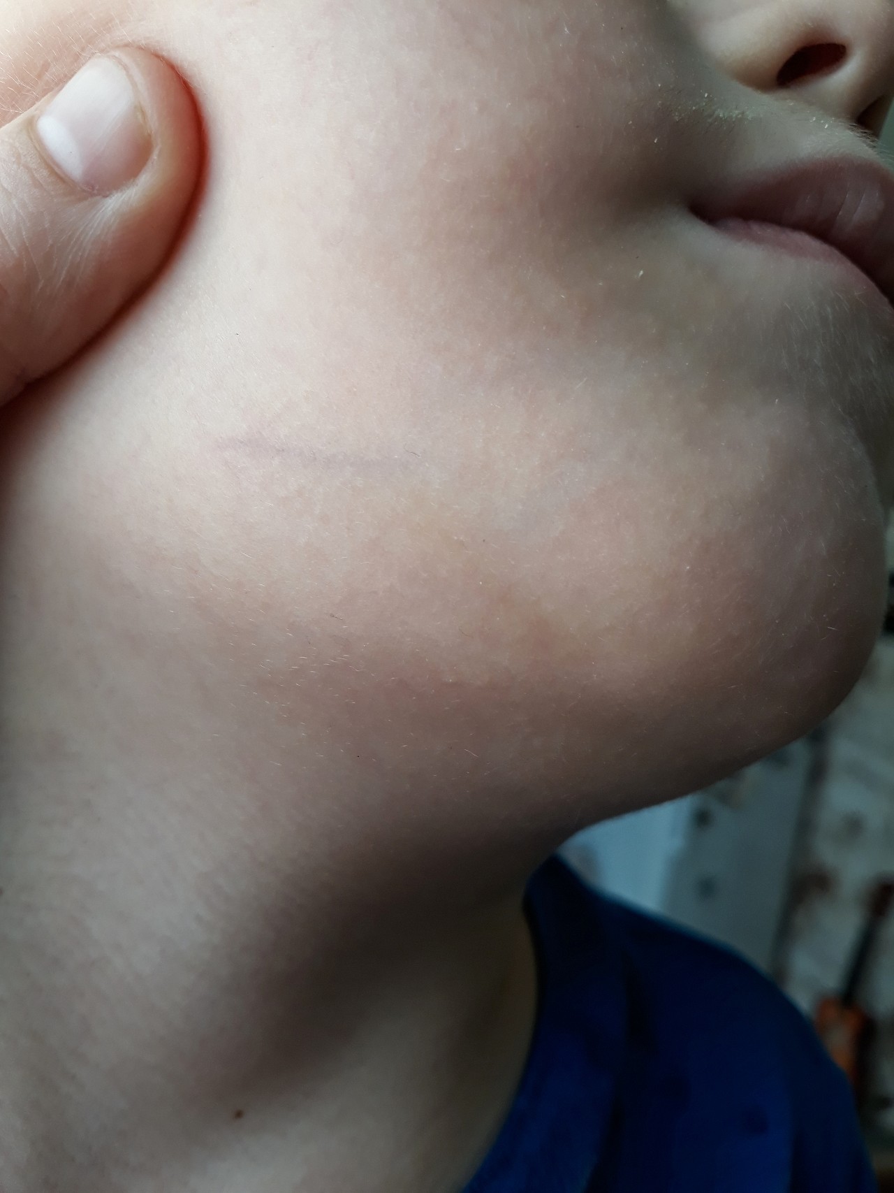 Мелкая сыпь на лице у ребенка