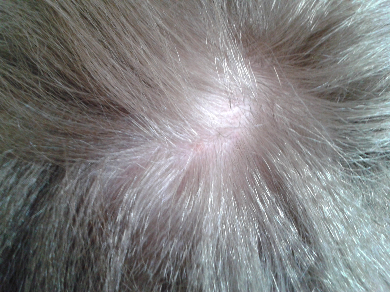 Асбестовидный лишай волосистой части головы