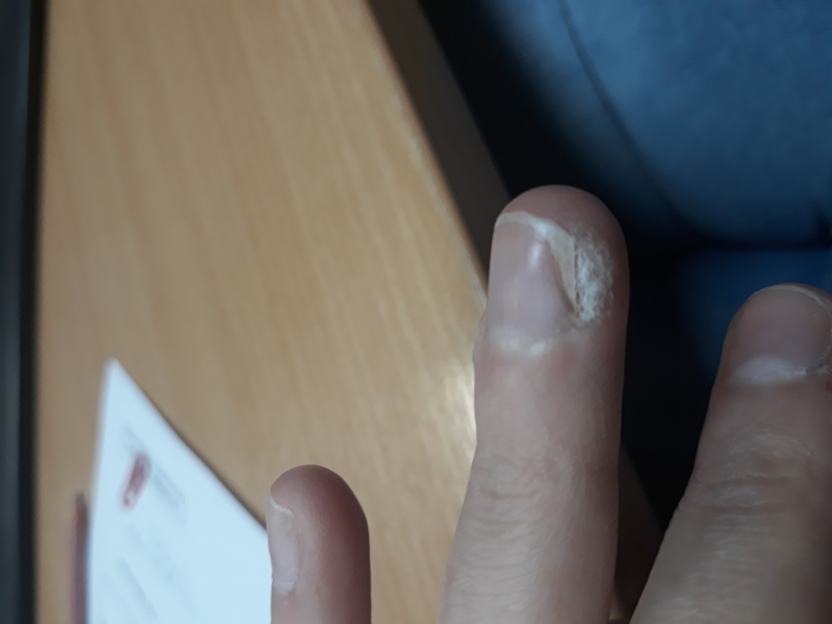 Нарост на пальце около ногтя