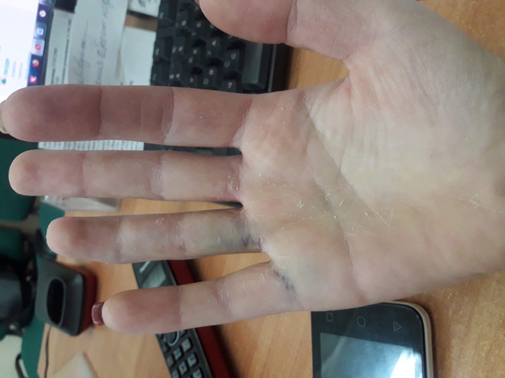 Перелом большого пальца на руке симптомы фото