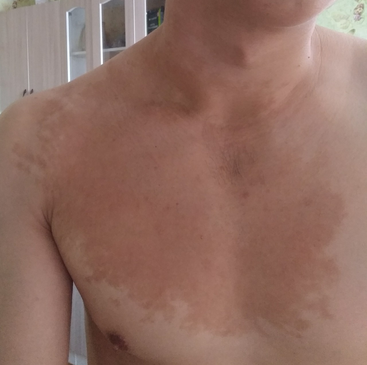 покраснение кожи на груди у мужчин причины фото 41