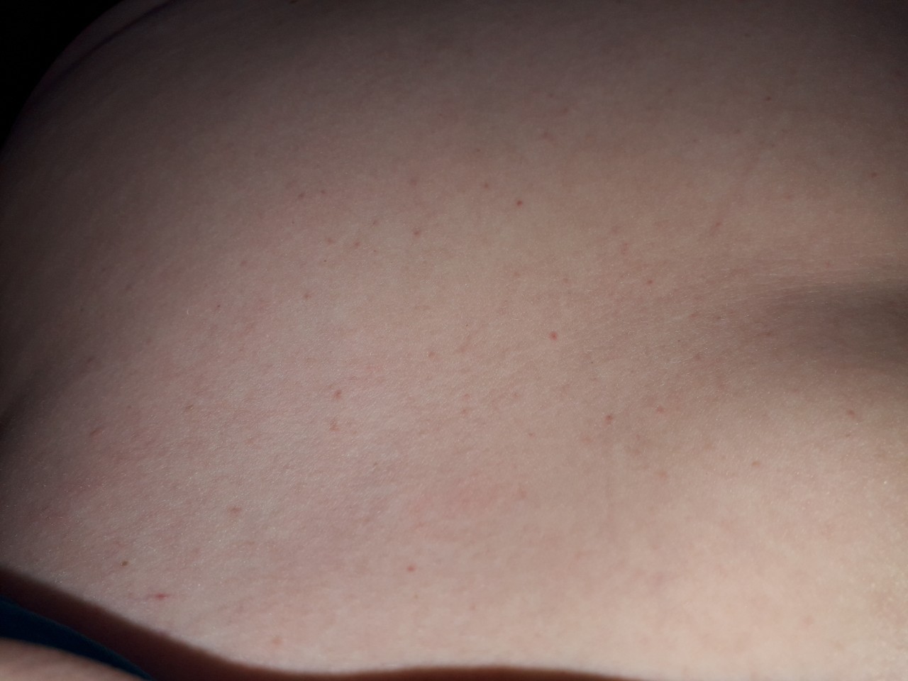 красные точки на груди беременность фото 75