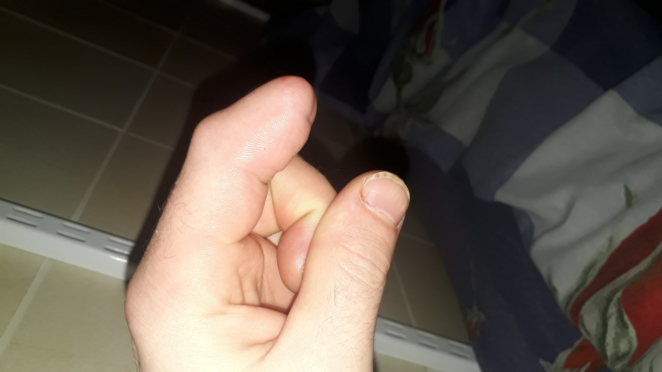 Ампутированный палец на руке