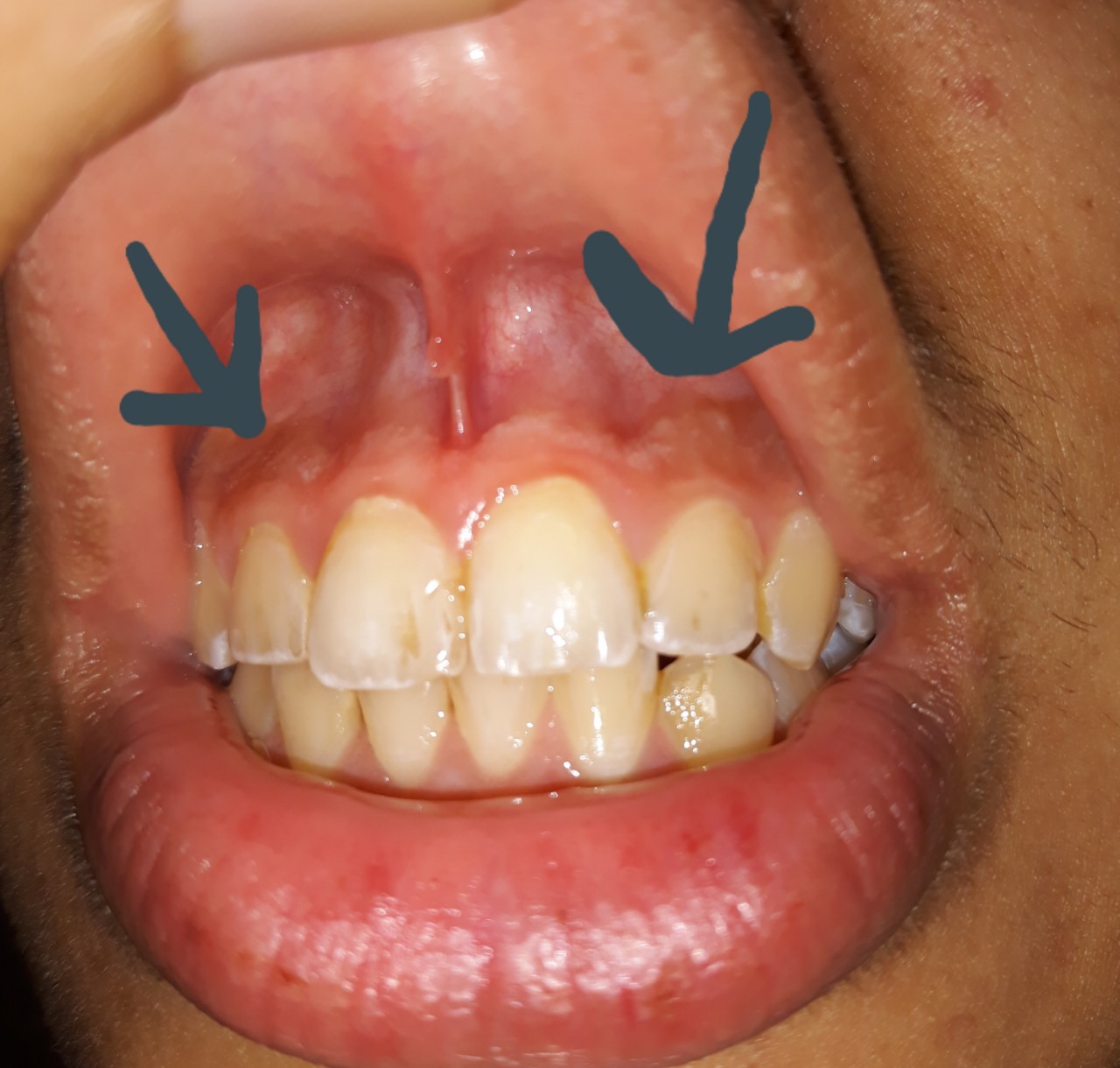Коричневые пятна на десне - Вопрос стоматологу - 03 Онлайн
