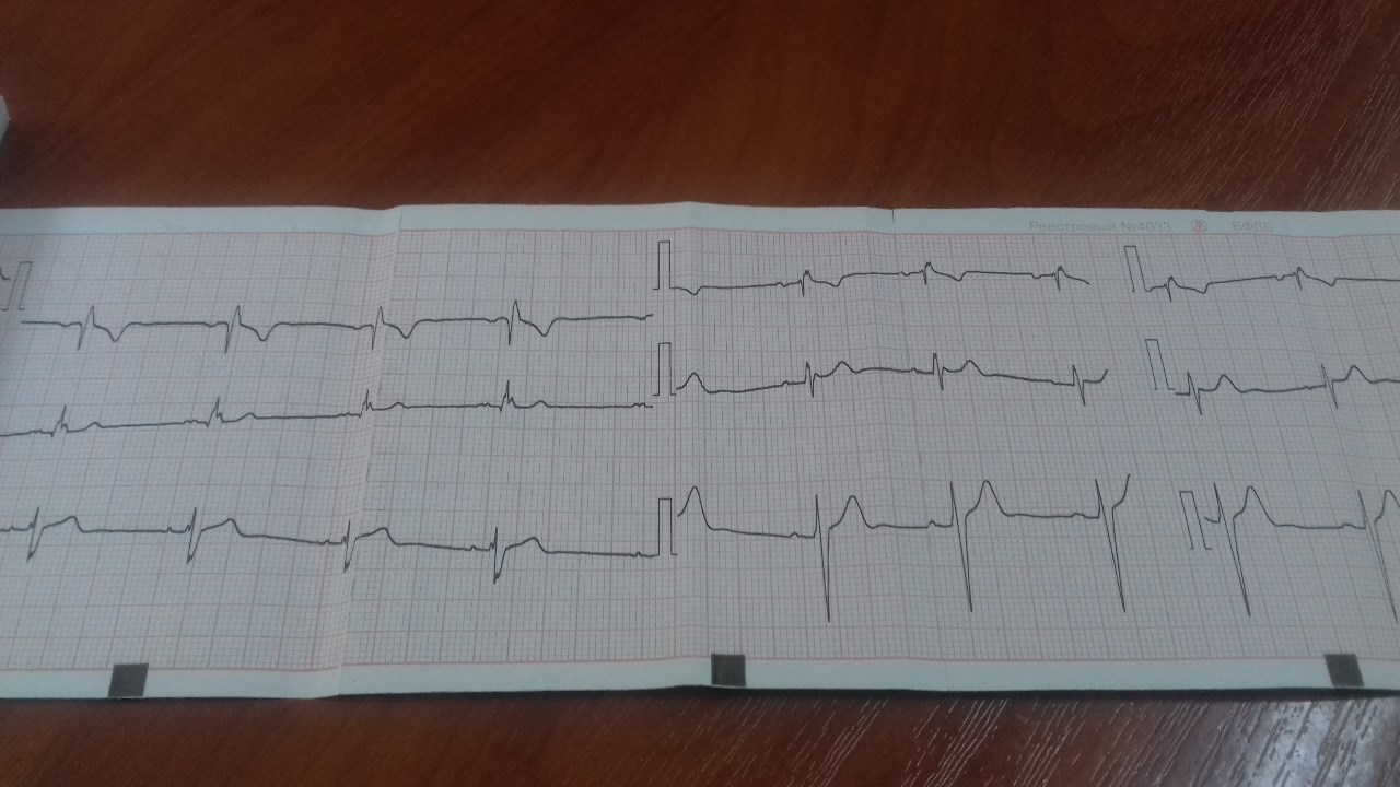 Экг блокады тест. БПВЛНПГ на ЭКГ. Кардиограмма сердца БПВЛНПГ.