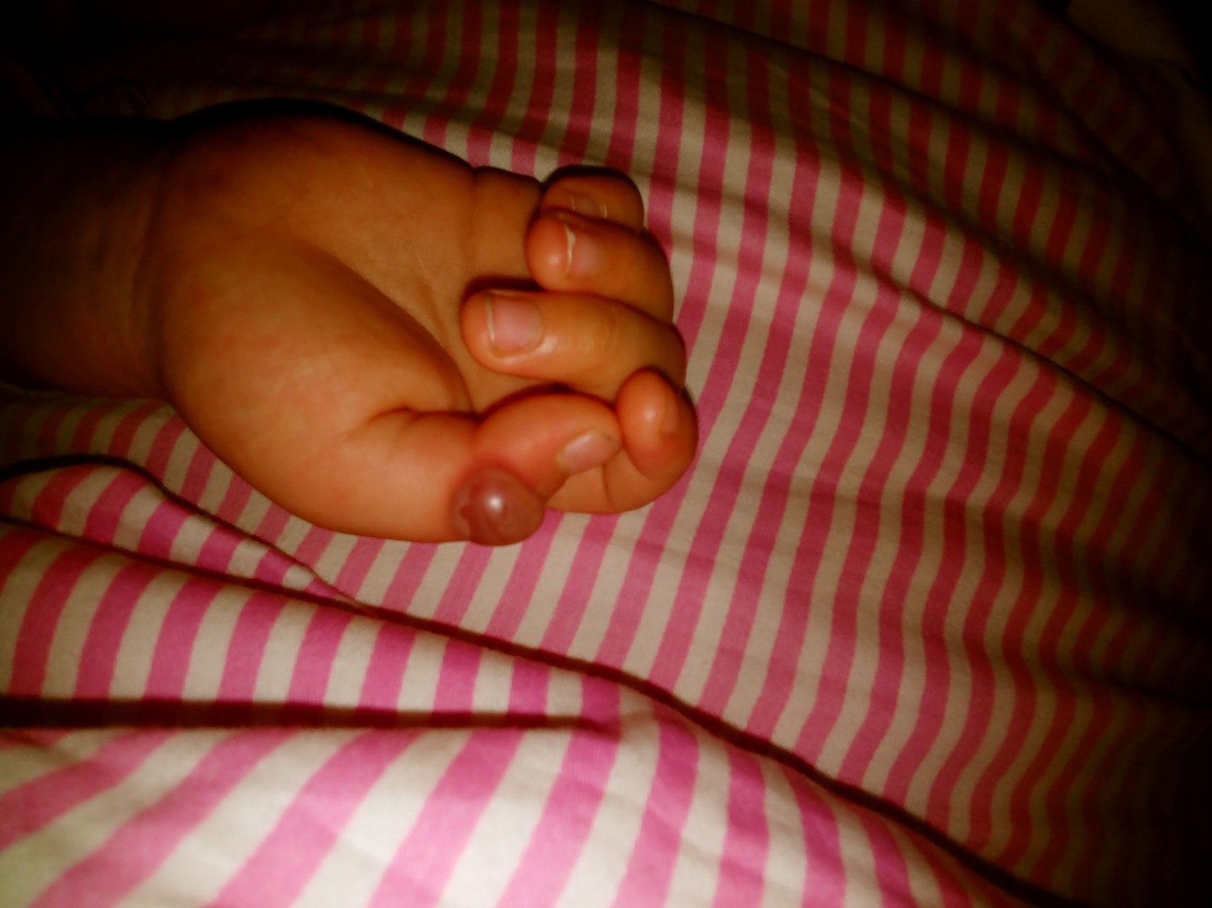 Шишка на пальце у ребенка