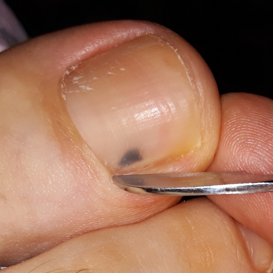 Что делать, если на пальце ноги появилась черная точка?