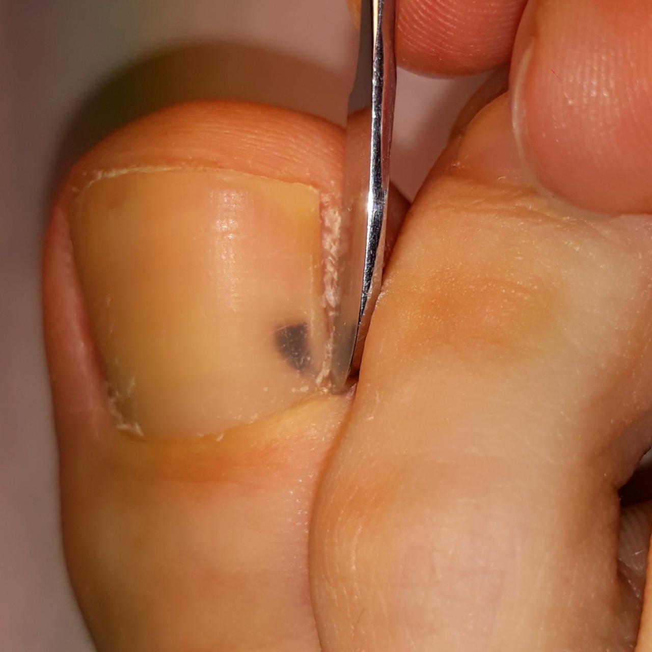 Темное пятно на ногте ноги (70 фото)