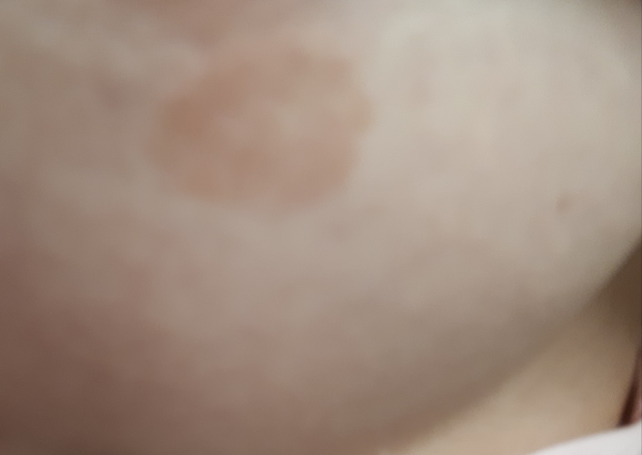 Pigment spots on the skin: causes, symptoms, treatment tactics, risks