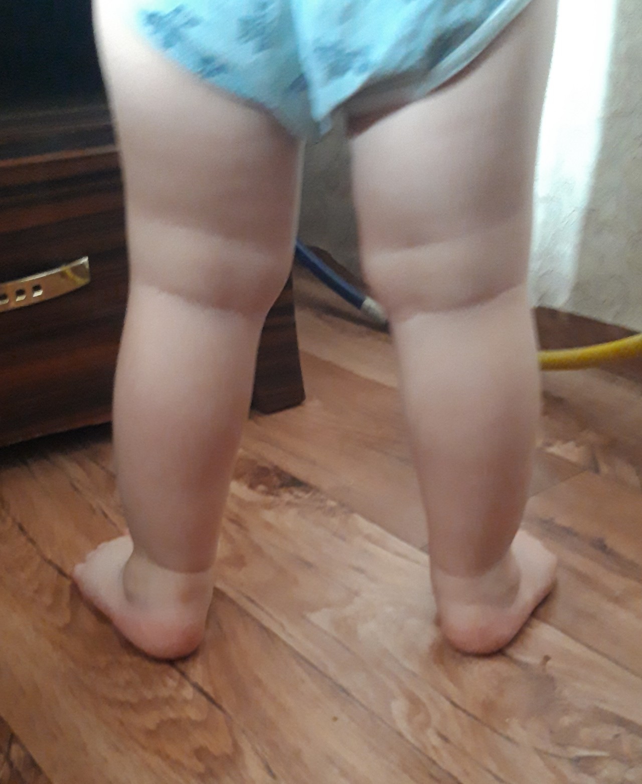 Плоскостопие у ребенка 1 год