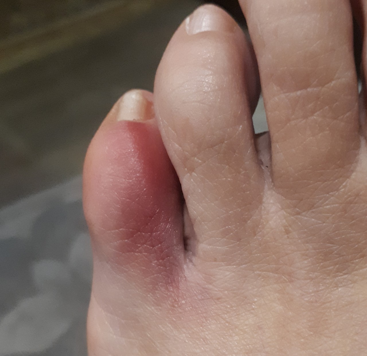 Типичные жалобы пациентов при болях в пальцах ног