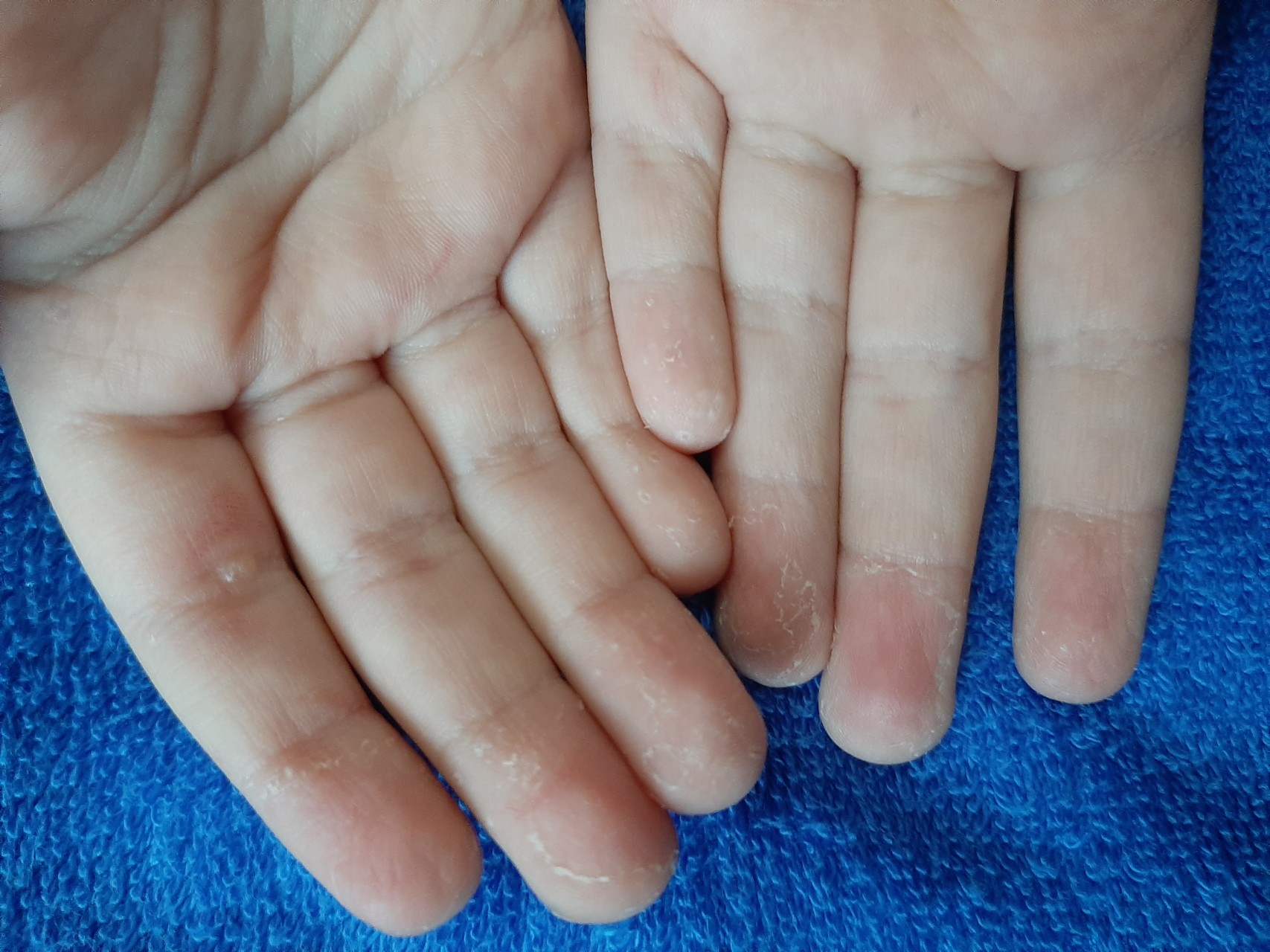 Шелушатся подушечки пальцев на руках у ребенка