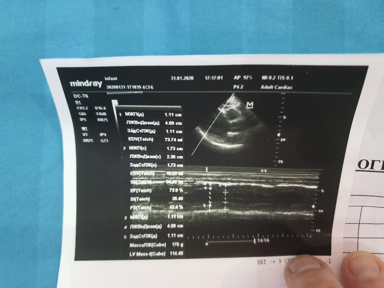 Расшифровка узи сердца у взрослого