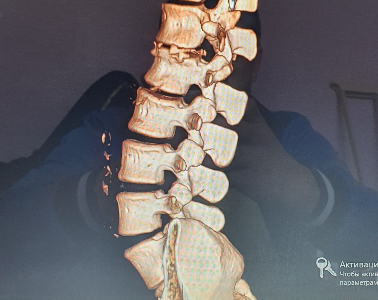 Перелом спины. Компрессионный перелом позвоночника тн10. Перелом 11 позвонка грудного отдела. Компрессионный перелом 5 позвоночника.