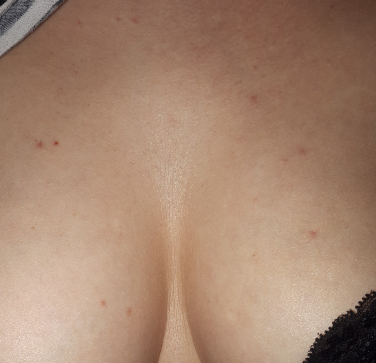 сыпь между грудей у женщин фото 19