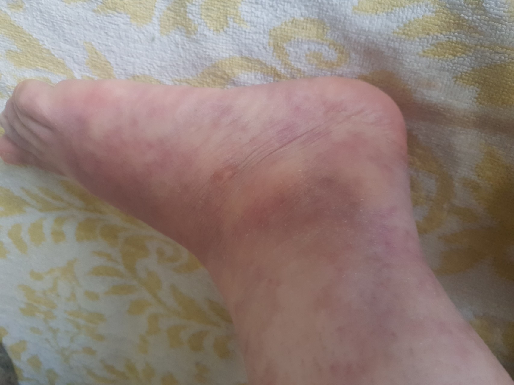 Аллергические пятна на ногах фото