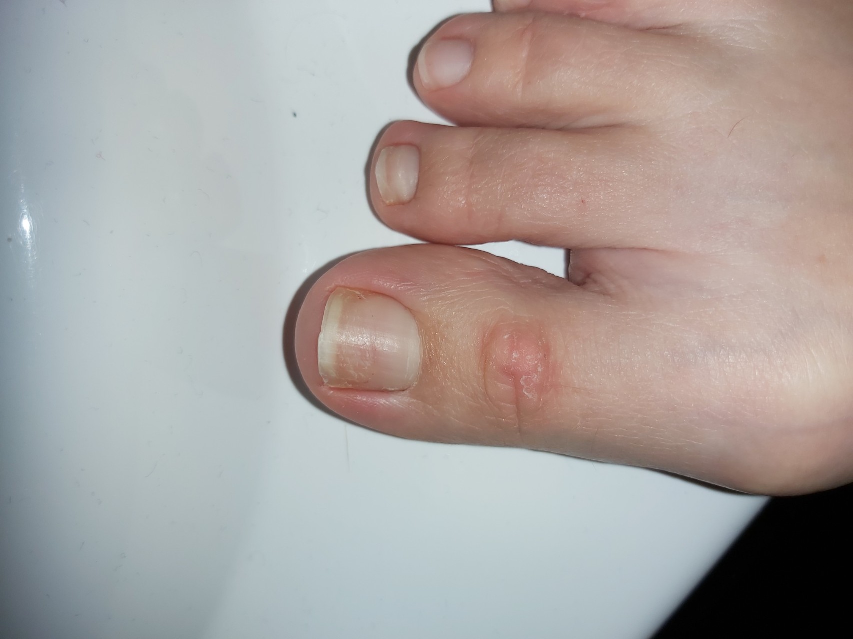 Сухое пятно на сгибе большого пальца ноги - Вопрос дерматологу - 03 Онлайн