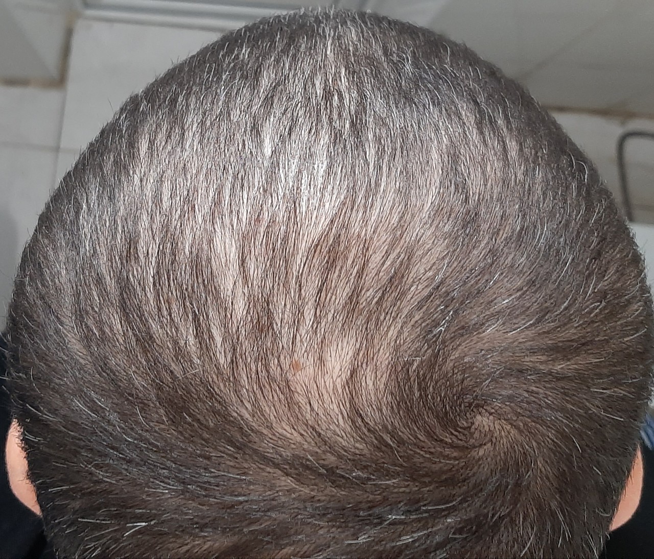 Выпадение волосы волосистой части головы