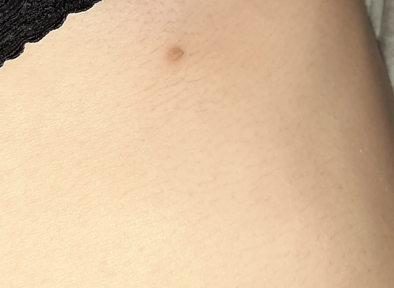 папилломы на груди у женщин фото 25