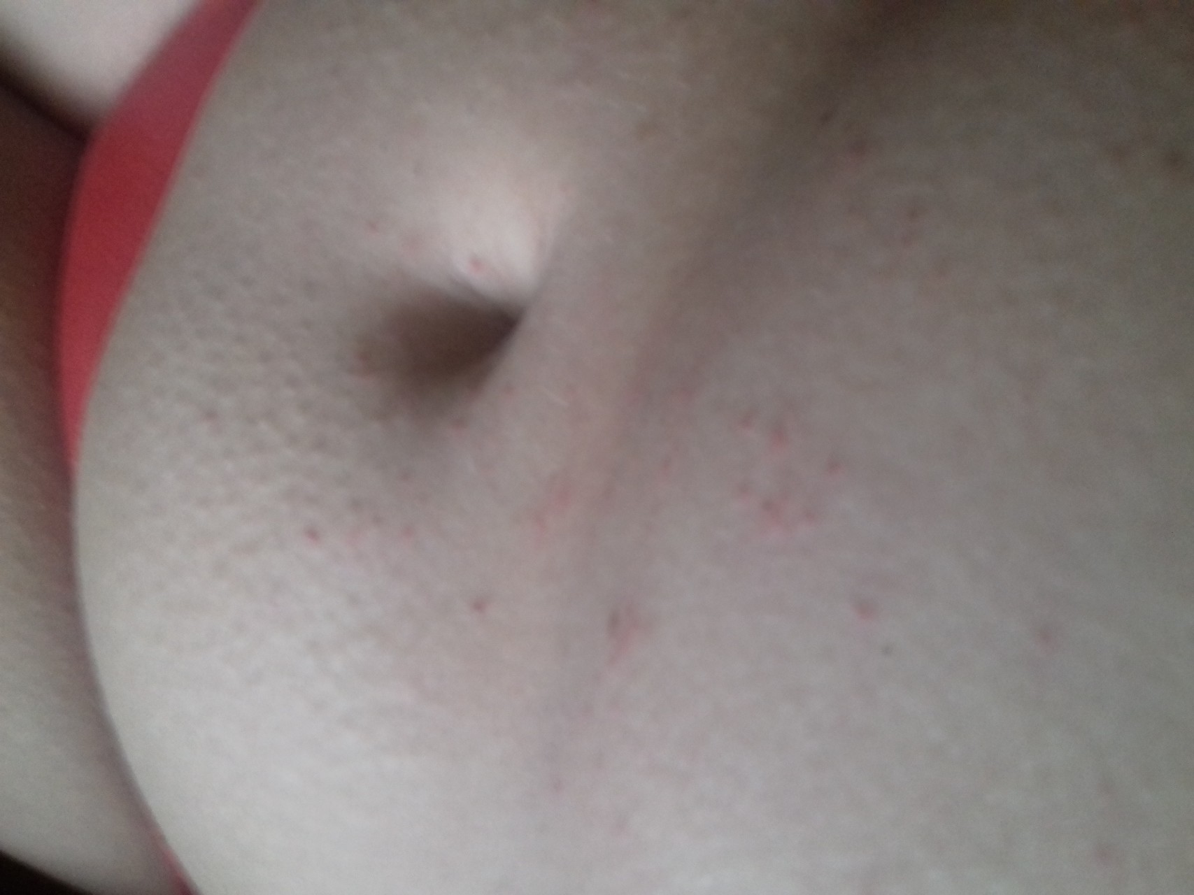 красные высыпания на груди у женщин фото 89