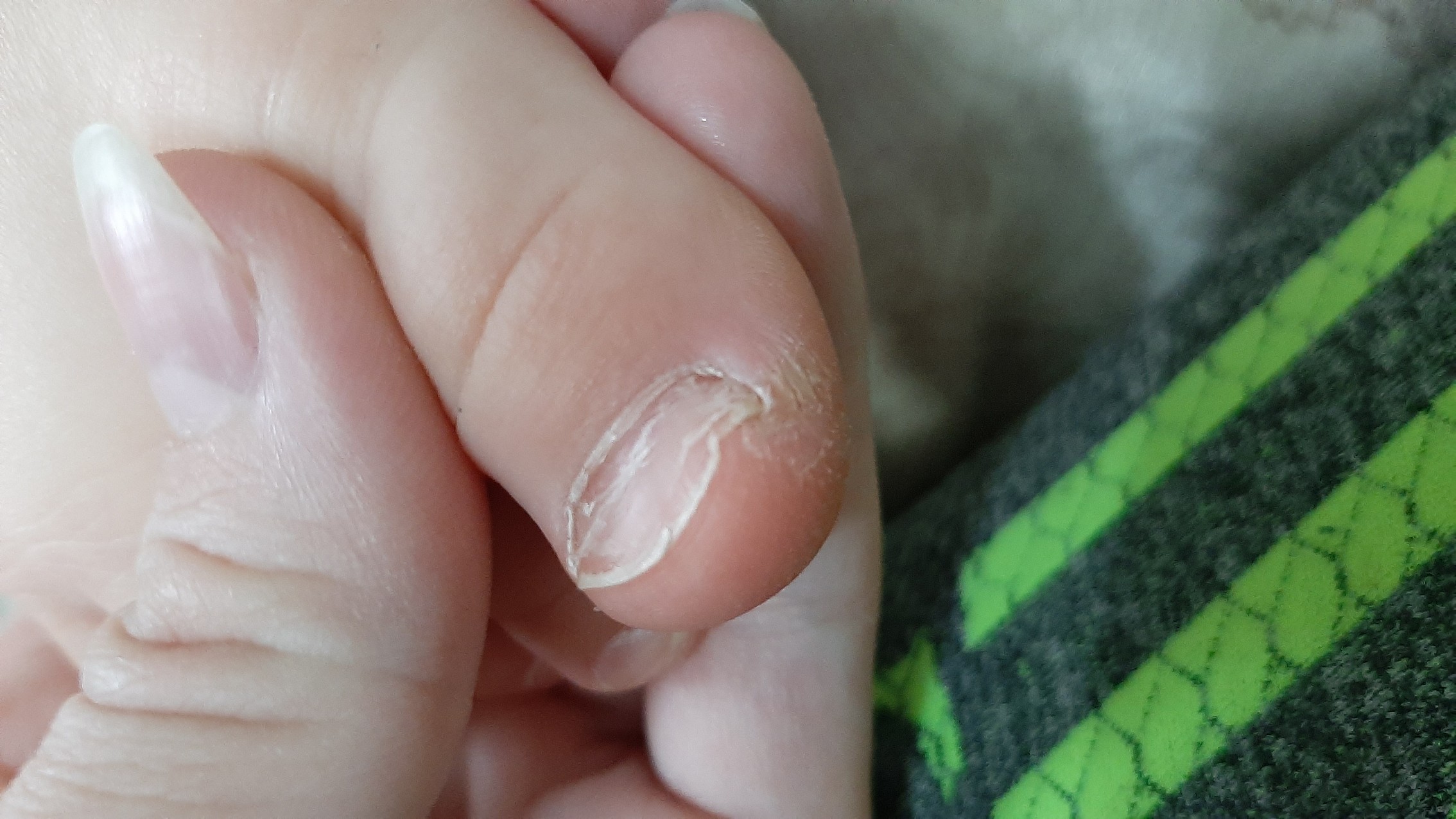 Чем опасен вирус коксаки, от которого у детей выпадают ногти?