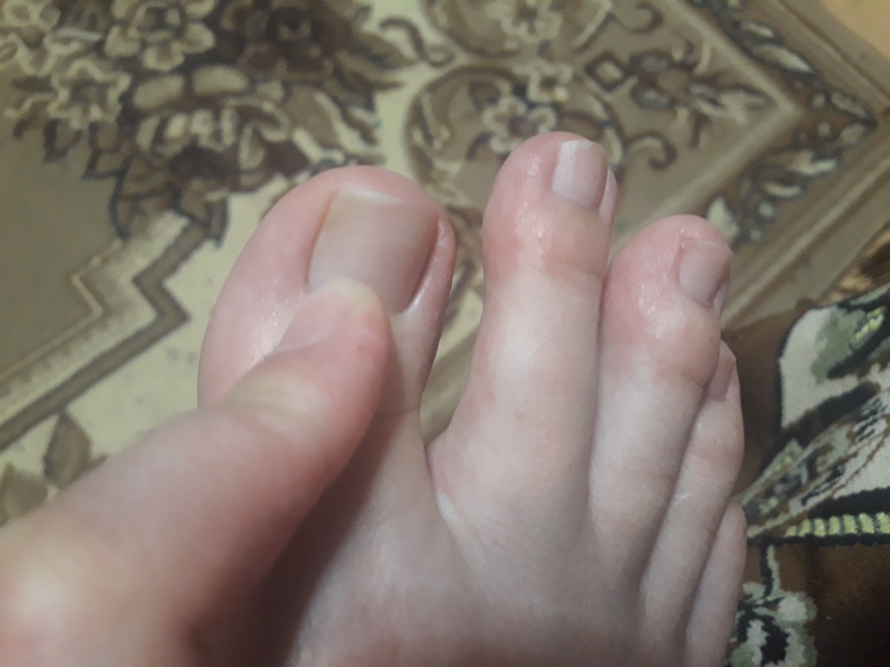 Красная сыпь на пальцах ног