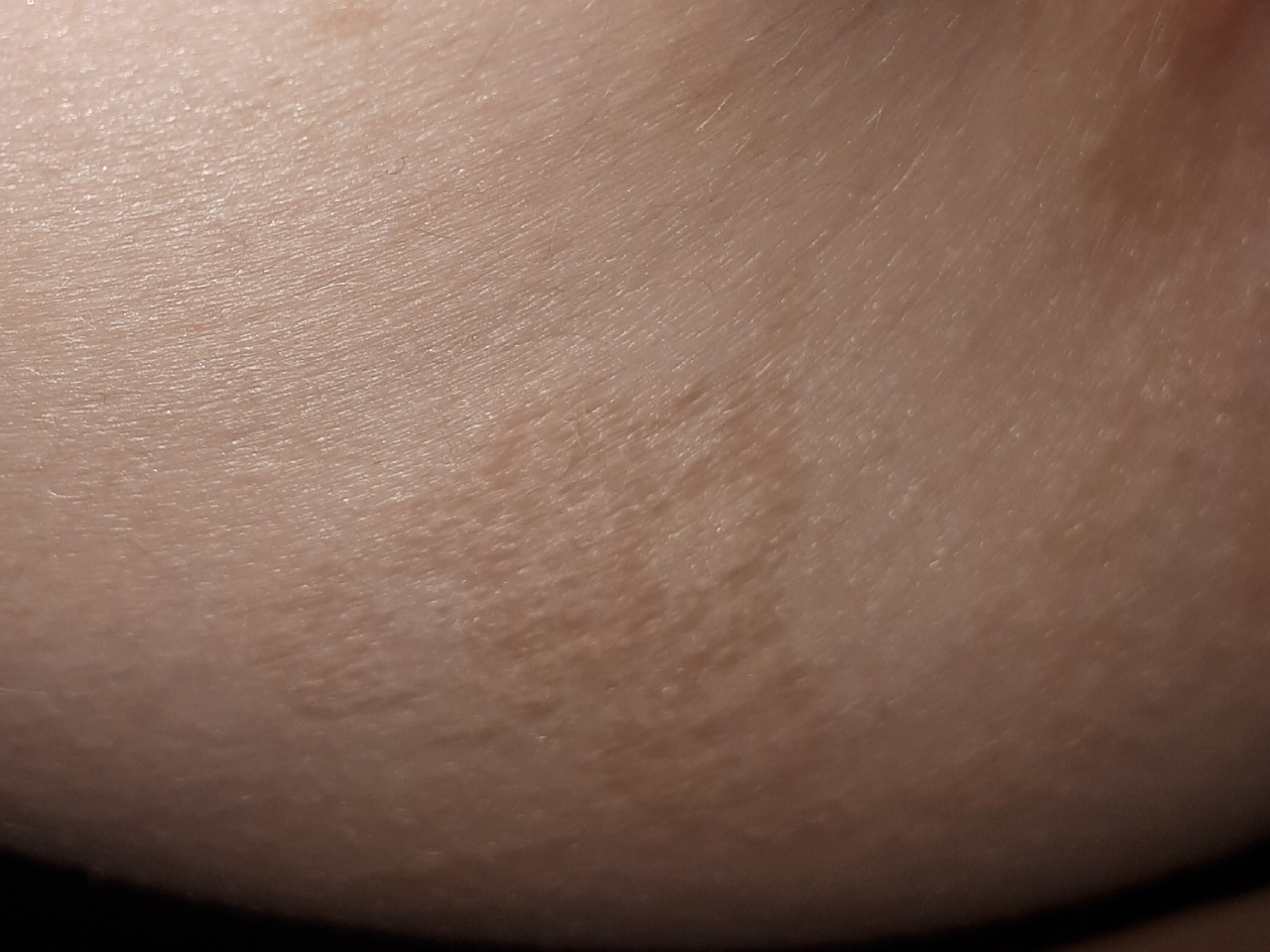 светло коричневые пятна на груди у женщин фото 29