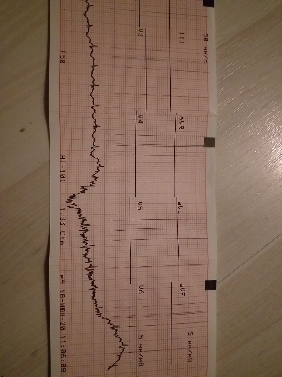 Расшифровка экг по фото. Расшифровка ЭКГ онлайн по фото. Гадаю по ЭКГ. Шкала при рождении ребенка при кардиограмме. Расшифровка ЭКГ 3х месячный ребенок.