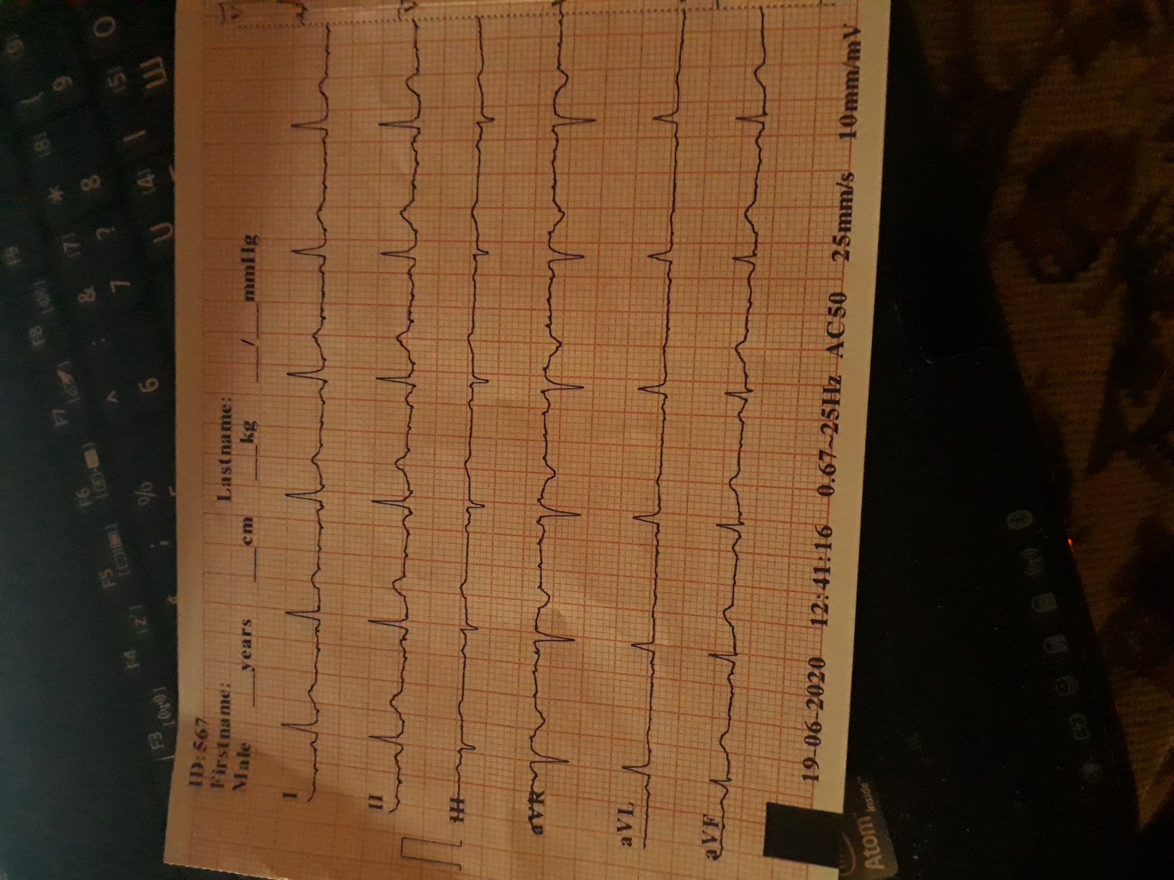 Сахарный диабет 2 типа, ожирение печени, артериальная гипертензия, вес ...