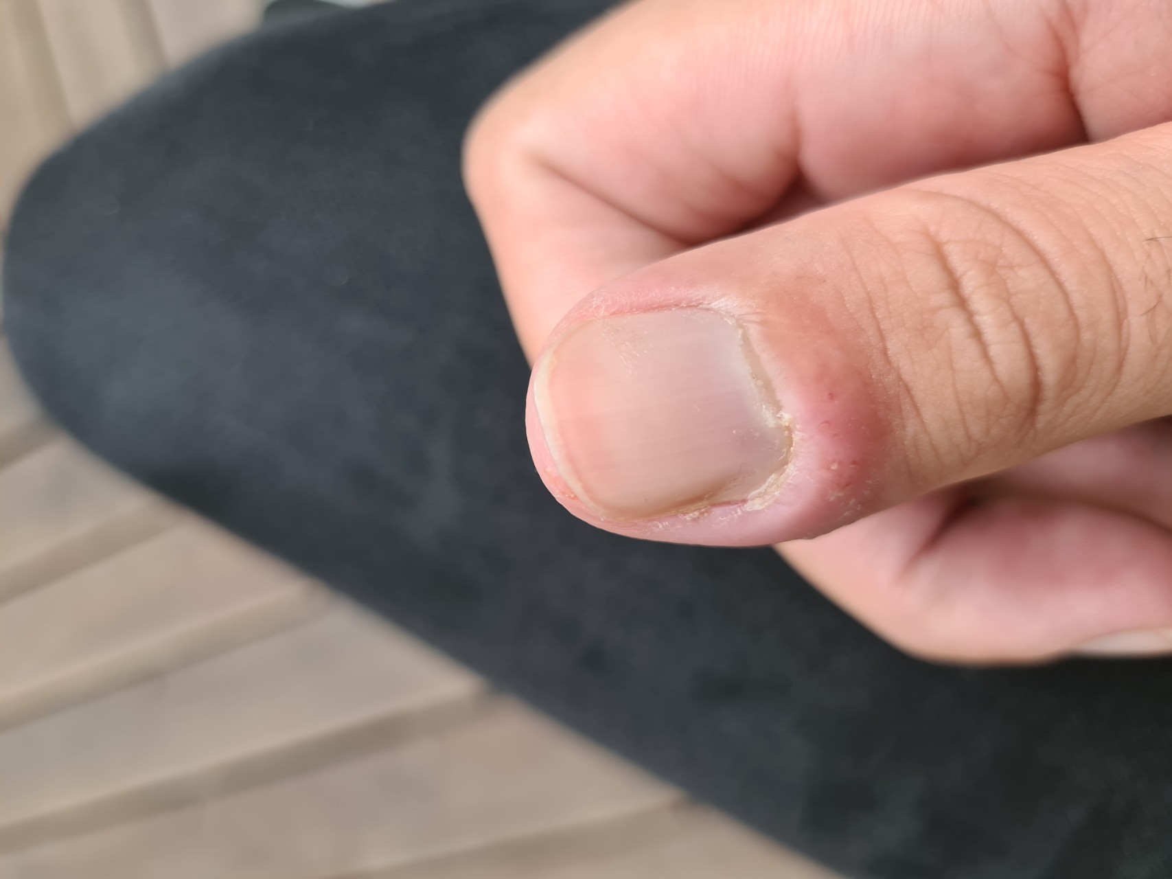 Бородавка на пальце руки около ногтя
