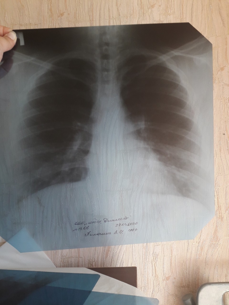 Рентген легких без патологий