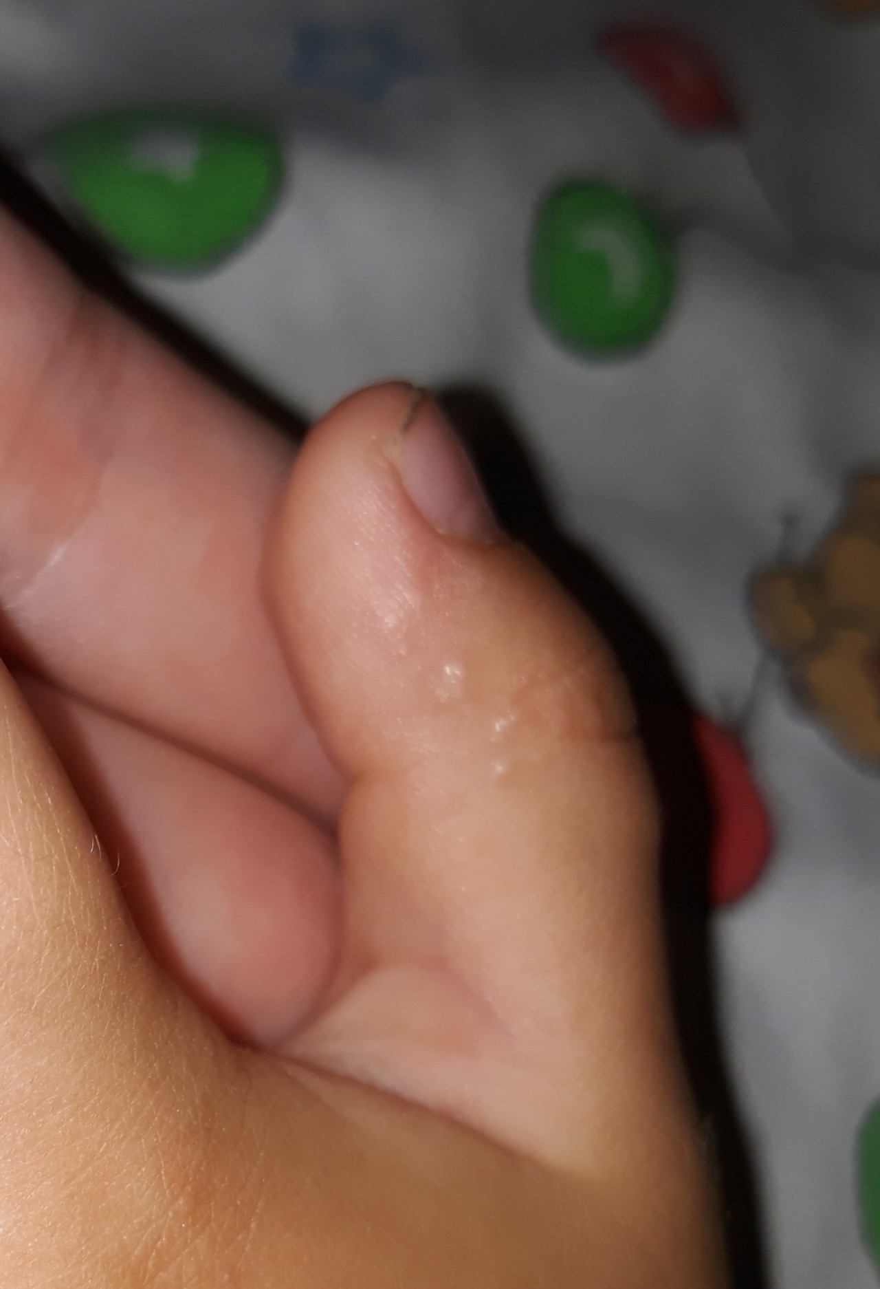 стрептодермия на пальчике ребенка фото