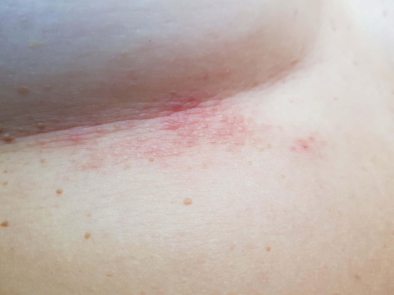 сыпь между грудей у женщин фото 61
