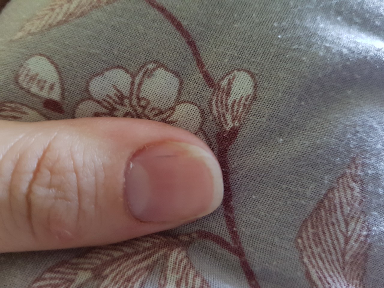 Темная полоска на ногте указательного пальца левой руки