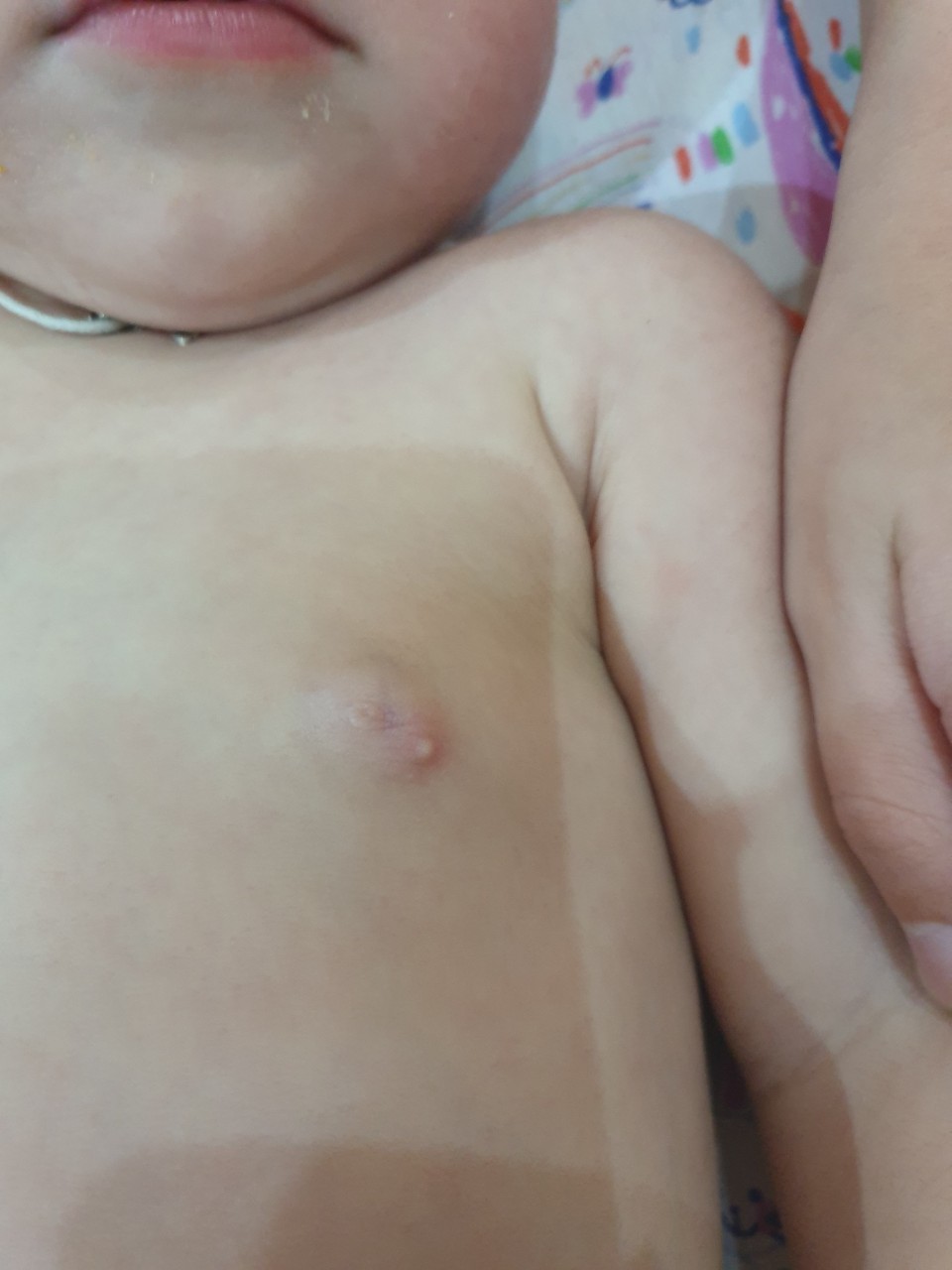 мелкие прыщики на груди при беременности фото 17