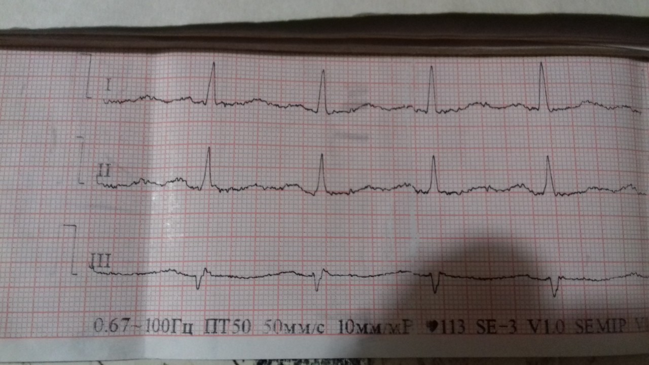 Как выглядит кардиограмма сердца здорового человека фото