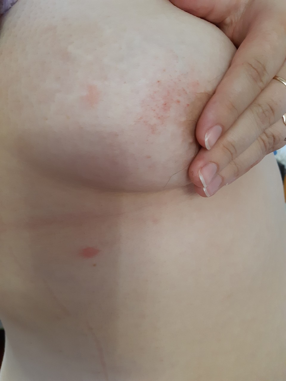 красные высыпания на груди у женщин фото 87
