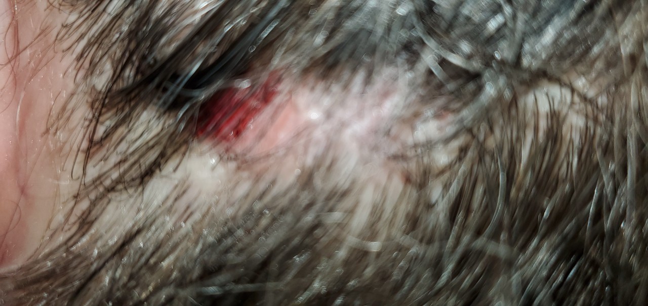 my-hair-has-small-white-balls-and-lesions-03